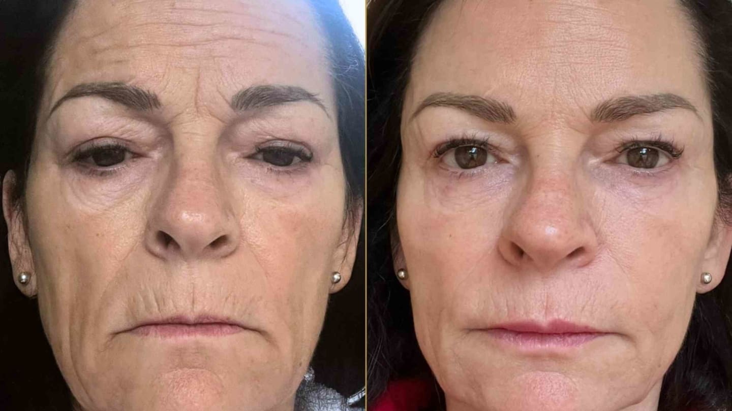 Endolift for Jowls Before and After Results - Dr Hass Clinic London