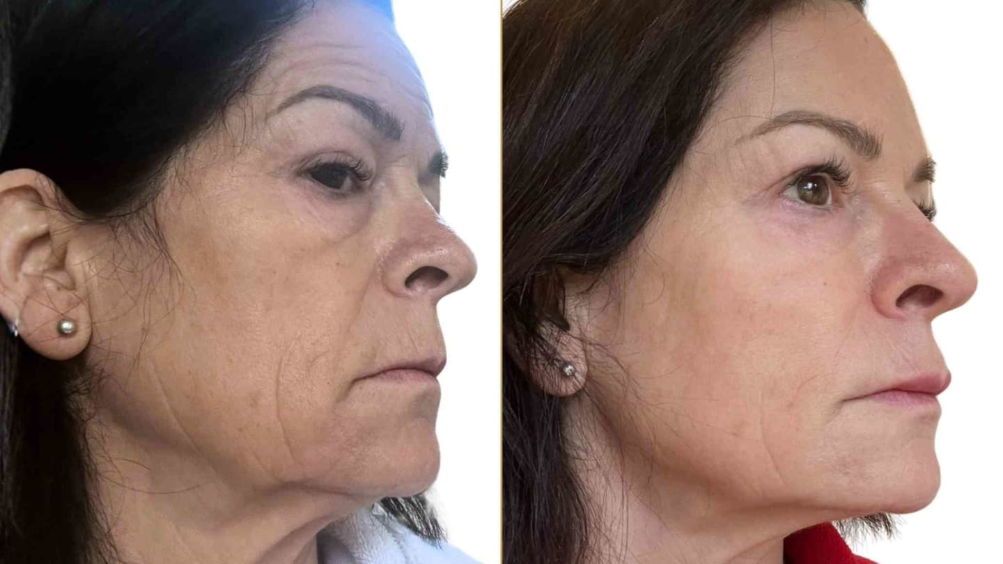 Endolift for Jowls Before and After Results - Dr Hass Clinic London