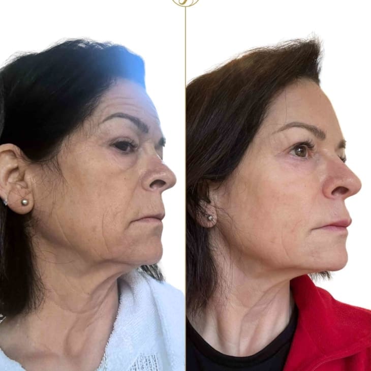 Endolift for Jowls Before and After Results - Dr Hass Clinic London