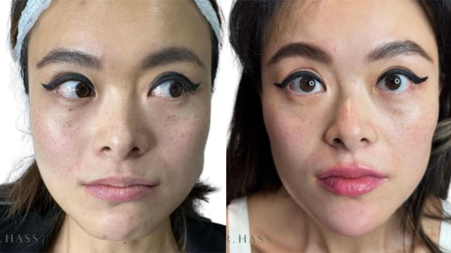 Masseter Botox (Masseter Reduction) Before and After Results - Dr Hass Clinic London