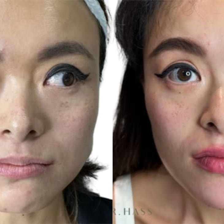 Masseter Botox (Masseter Reduction) Before and After Results - Dr Hass Clinic London