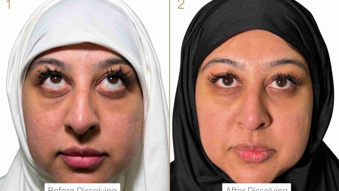 Hyaluronidase Before and After - Dr Hass Clinic