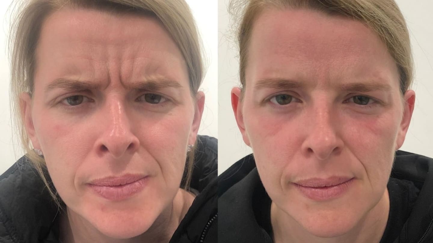 Anti-Wrinkle Injections - Before and After Forehead - Dr Hass Clinic