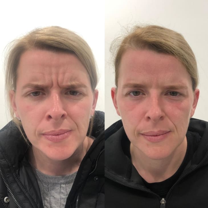 Anti-Wrinkle Injections - Before and After Forehead - Dr Hass Clinic