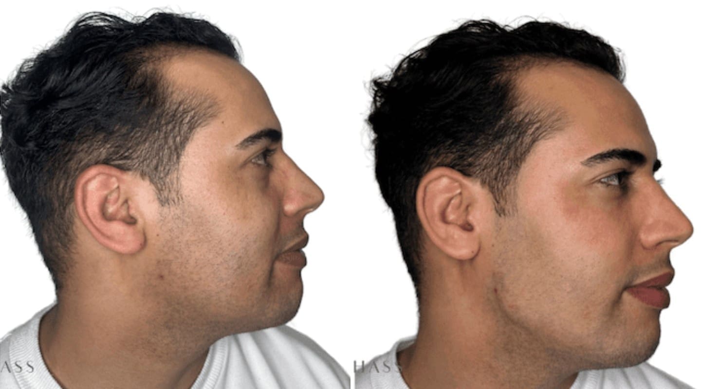 Jawline Filler Before and After - Dr Hass Clinic
