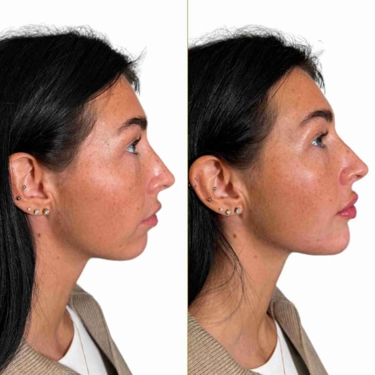 Profile Balancing Before and After Gallery - Dr Hass Clinic