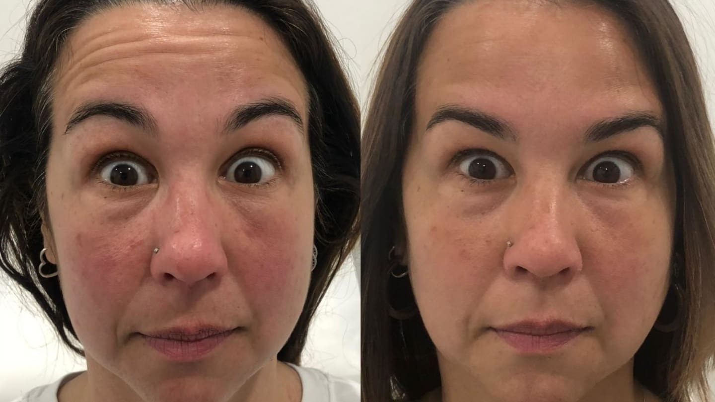 Anti-Wrinkle Injections Forehead - Female Patient - Dr Hass Clinic