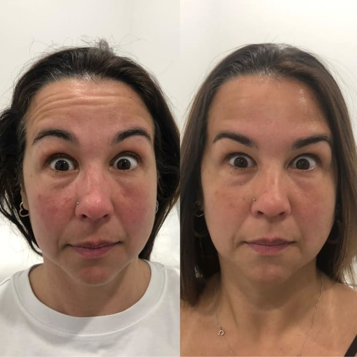 Anti-Wrinkle Injections Forehead - Female Patient - Dr Hass Clinic