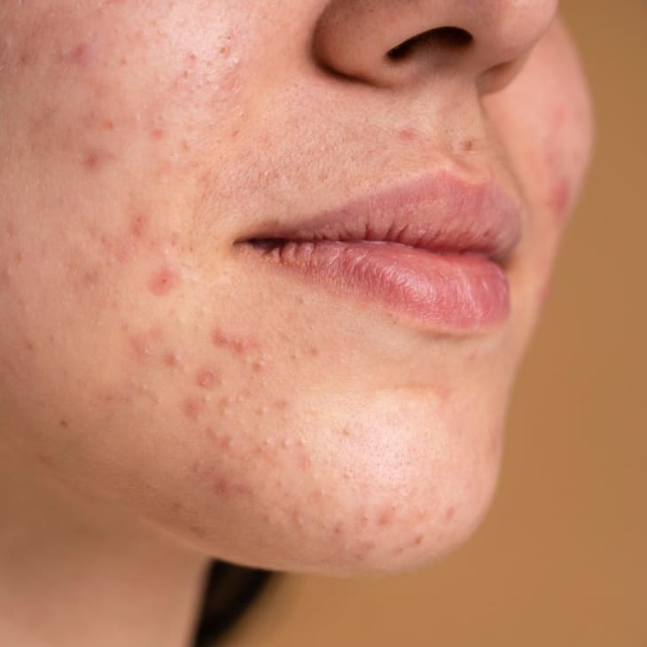 Benefits of Microneedling for Acne Scars