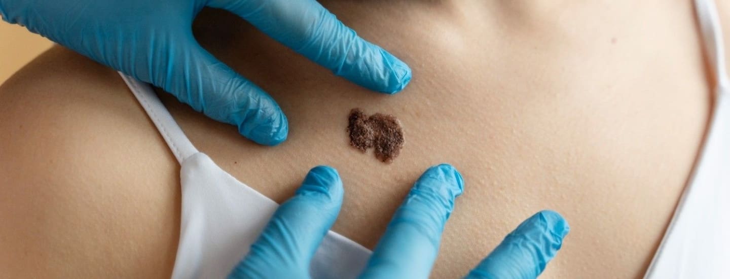 CryoPen Treatment - Dr Hass Clinic in London