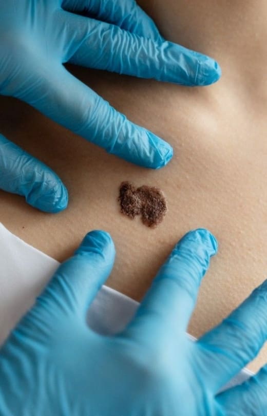 CryoPen Treatment - Dr Hass Clinic in London