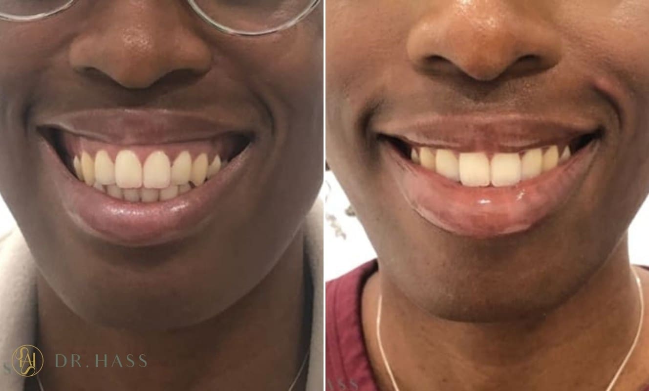 Gummy Smile Treatment - Before and After - Dr Hass Clinic