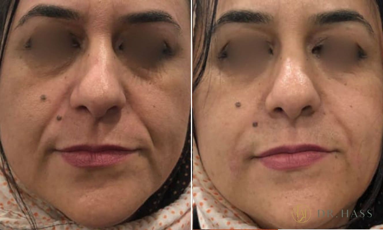 Nasolabial Filler - Before and After 1 - Dr Hass Clinic