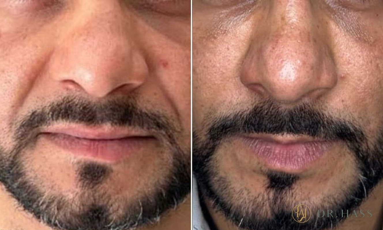 Nasolabial Filler - Before and After 2 - Dr Hass Clinic