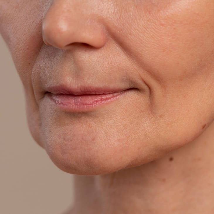 Nasolabial Filler Recovery and Aftercare - Dr Hass Clinic