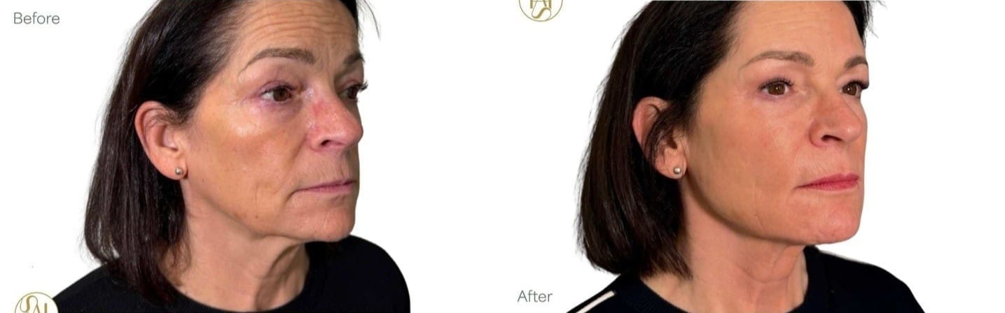 Nefertiti Neck Lift - What to Expect from Treatment - Before and After - Dr Hass Clinic
