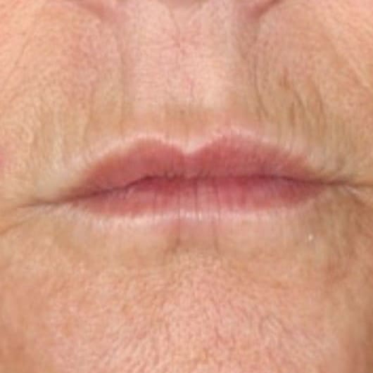 XERF Laser After 1 - Dr Hass Clinic