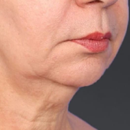 XERF Laser After 2 - Dr Hass Clinic