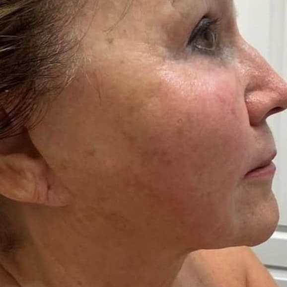XERF Laser After 3 - Dr Hass Clinic