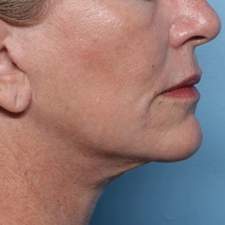 XERF Laser After 4 - Dr Hass Clinic