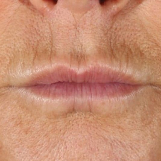XERF Laser Before 1 - Dr Hass Clinic