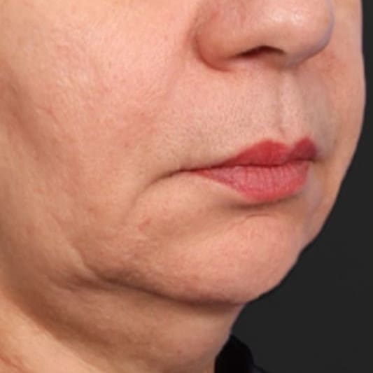 XERF Laser Before 2 - Dr Hass Clinic