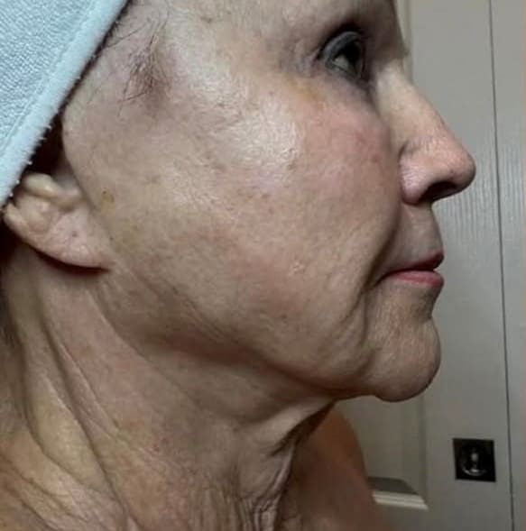 XERF Laser Before 3 - Dr Hass Clinic
