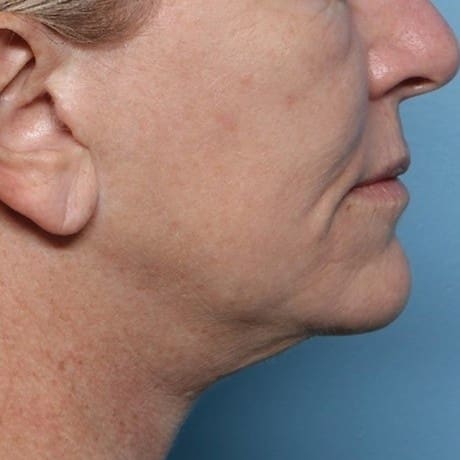 XERF Laser Before 4 - Dr Hass Clinic