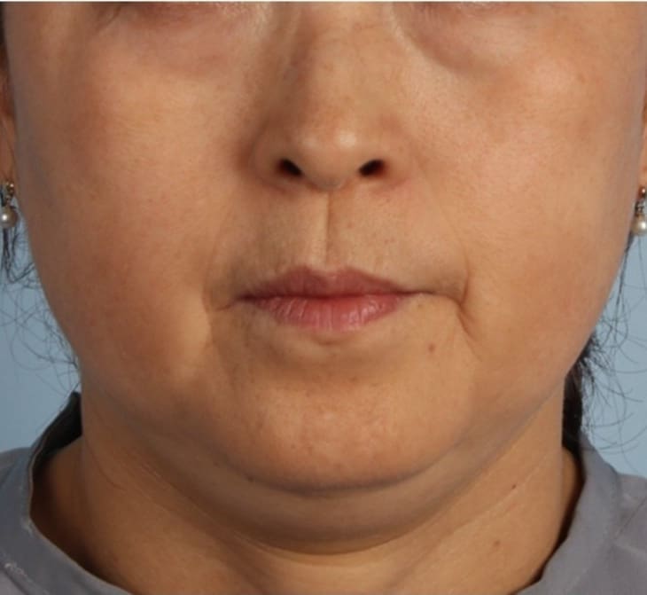 Does XERF Cause Fat Loss - Dr Hass Clinic