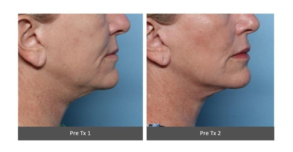 XERF Before and After - Jawline - Dr Hass Clinic