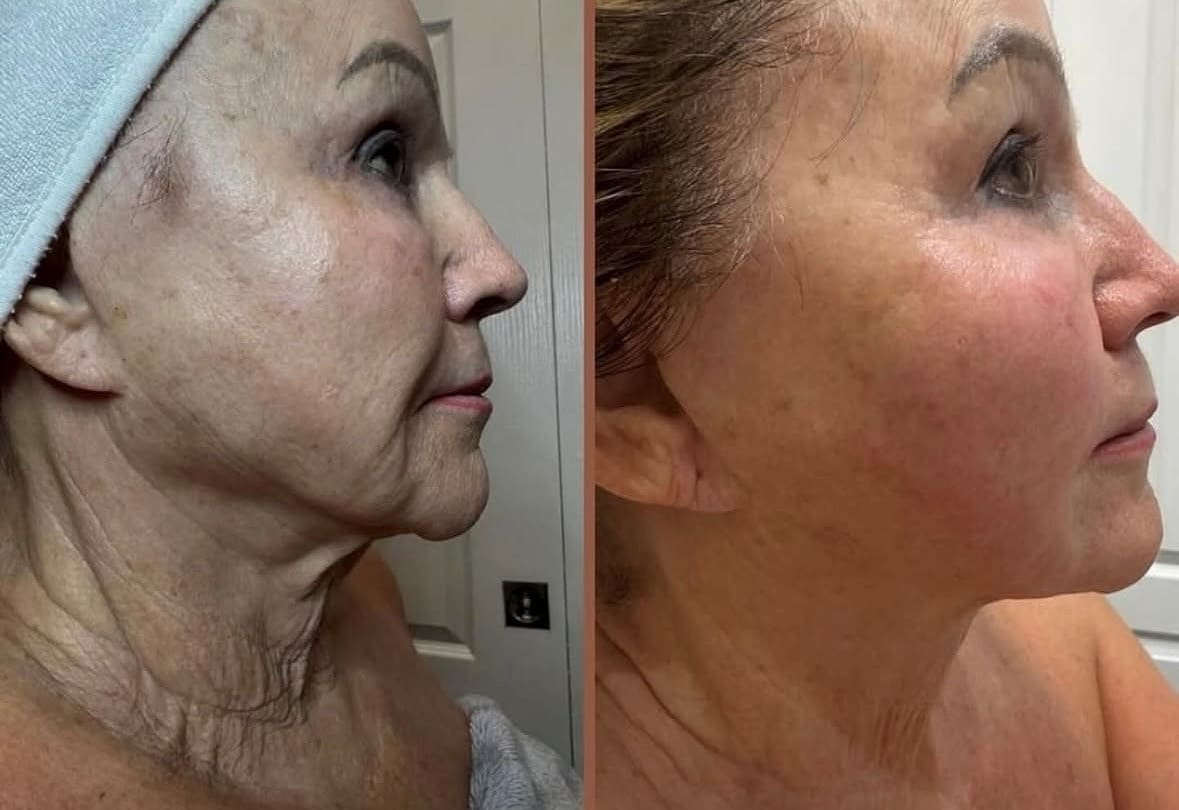 XERF Before and After - Skin Laxity - Dr Hass Clinic