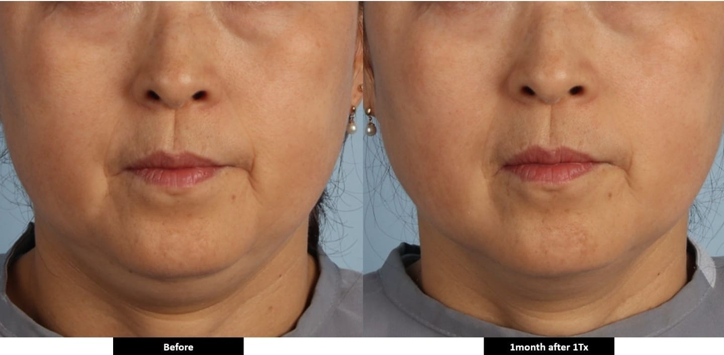 XERF Before and After - Submental Reduction - Dr Hass Clinic